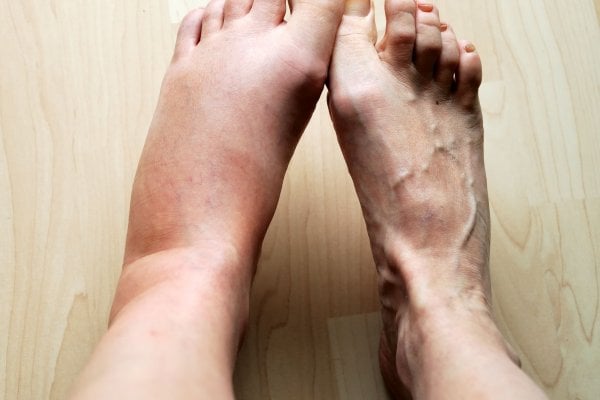 swollen-leg-royalty-free-image-176978128-1561645339