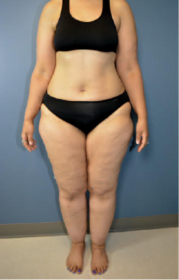 woman-with-lipedema