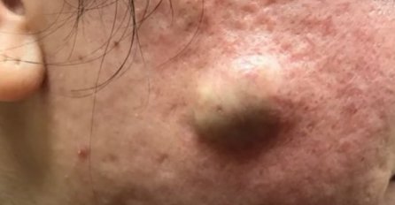 OGROMNA IZRASLINA MU JE GODINAMA BILA NA OBRAZU: Otišao je u bolnicu da mu to iscijede, POGLEDAJTE ŠTA JE IZAŠLO (VIDEO)
