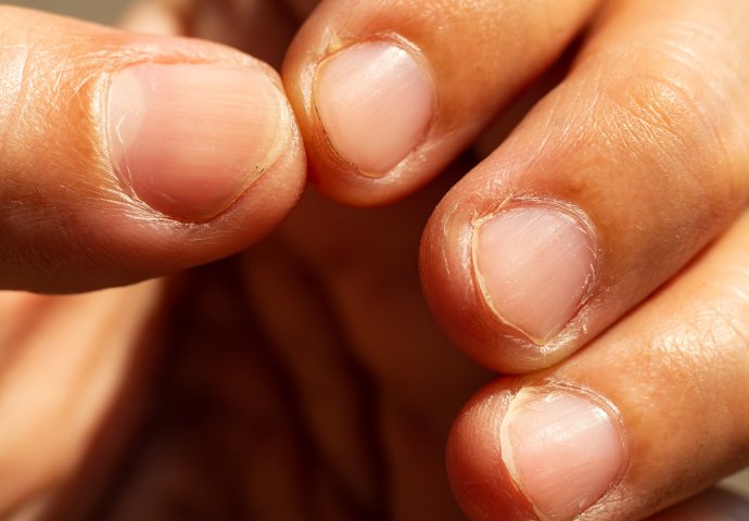 DOBRO SE ZAGLEDAJTE U RUKE I OTKRIJTE DA LI VAM PRIJETI INFARKT: Kardiolozi upozorili - ovo nikako ne želite da vidite