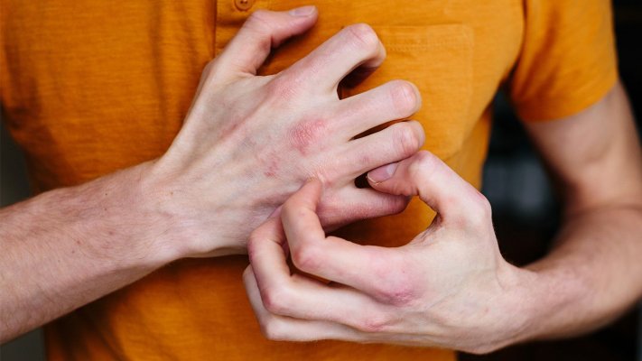 how-long-does-eczema-last-1440x810