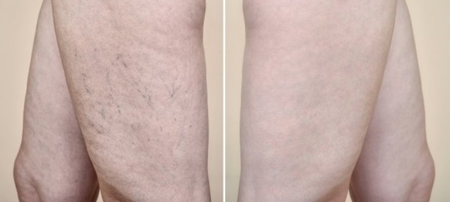 legs-woman-varicose-veins-capillaries-260nw-1158934870