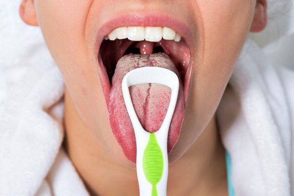 coated-tongue