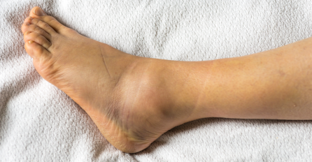 DA LI IMATE POVIŠENE MASNOĆE U KRVI? Simptomi se pojavljuju na stopalima POGLEDAJTE ODMAH I SAZNAJTE