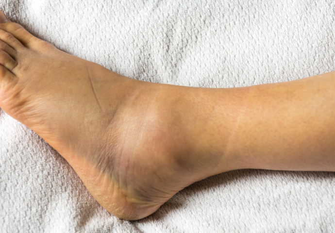 DA LI IMATE POVIŠENE MASNOĆE U KRVI? Simptomi se pojavljuju na stopalima POGLEDAJTE ODMAH I SAZNAJTE