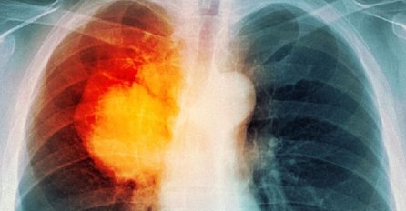 Kašalj nije prvi simptom raka pluća! Ovo je JASAN SIGNAL DA SE U VAŠEM TIJELU RAZVIJA, primjetite ovo ODMAH se javite ljekaru