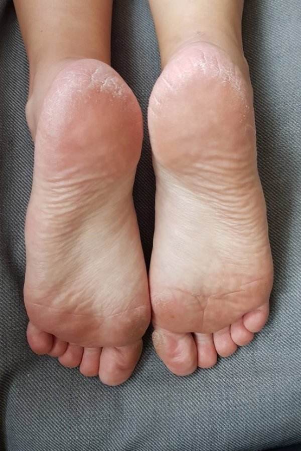 i-tried-peeling-socks-to-get-rid-of-dry-skin