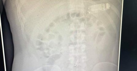 Pacijentu u Prištini ljekari izvadili mobitel iz stomaka