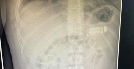 Ljekari u Prištini nisu mogli da vjeruju šta vide u stomaku pacijenta: SVI SE PITAJU KAKO JE OVO MOGUĆE (FOTO)