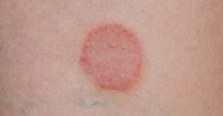 ZAŠTO VAM SE NA KOŽI POJAVIO LIŠAJ? OBRATITE PAŽNJU NA OVE SIMPTOME: Evo šta trebate znati