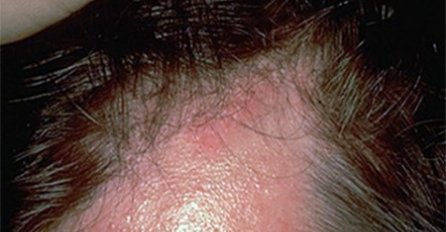 SIMPTOMI KOJI UKAZUJU NA VISOK KRVNI PRITISAK: Evo kako da prepoznate visok pritisak bez aparata za mjerenje, ZNAK BROJ 3. SVI ZANEMARUJU!