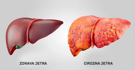 MASNA JETRA JE ČEST PROBLEM KOD MNOGIH: Ovaj prirodni napitak čisti jetru u potpunosti, EVO KAKO SE PRAVI