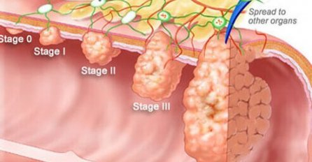 7 PRVIH SIMPTOMA RAKA DEBELOG CRIJEVA: 90% ljudi IGNORIŠE ALARM koji tijelo šalje!