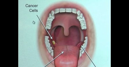 OVO SU PRVI SIMPTOMI RAKA GRLA: Mnogi ljudi ih ignorišu jer misle da su bezopasni, A ZAPRAVO SU ZNAK ZA UZBUNU
