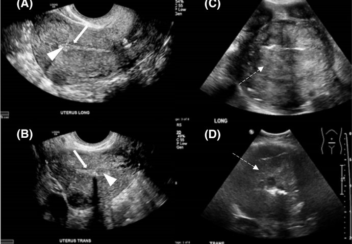 OD RAKA MATERICE UMIRE SVE VEĆI BROJ ŽENA: 6 jasnih signala da se u tijelu razvija ovaj opasan tumor!