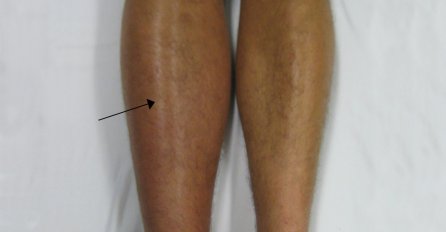 Znate li kako prepoznati KRVNE UGRUŠKE? 8 znakova koje ne smijete ignorisati