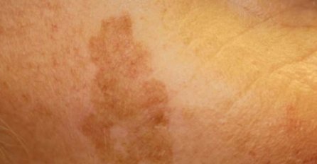 RECEPT KOJI JE MNOGIMA POMOGAO: Evo kako da skinete starčke pjege i smeđe mrlje sa ruku (RECEPT ZA SMJESU)