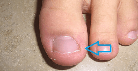 GLJIVICE NA NOKTIMA NESTAJU KAO OD ŠALE: Ova smjesa je mnogima pomogla, evo kako da izliječite ovu neugodnost (RECEPT)