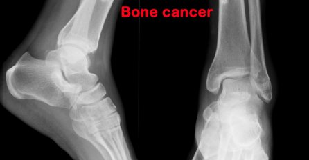 OVO SU PRVI SIMPTOMI RAKA KOSTIJU: Bolest često počinje bez simptoma, ali ako ovo primijetite - OBAVEZNO SE JAVITE LJEKARU 