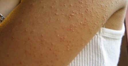 DA LI VAM SMETA GLUTEN? OVE ZNAKOVE NA TIJELU NE SMIJETE ZANEMARITI: Ovako vas organizam upozorava