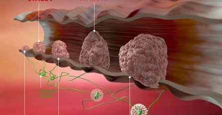 7 PRVIH SIMPTOMA RAKA DEBELOG CRIJEVA: 90% ljudi IGNORIŠE ALARM koji tijelo šalje!
