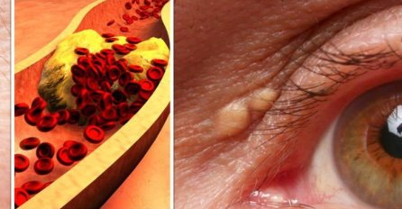 2 SIMPTOMA OTKRIVAJU VISOK HOLESTEROL I BEZ ANALIZE KRVI: Ljekari upozorili na skrivene signale koje ne smijete ignorisati