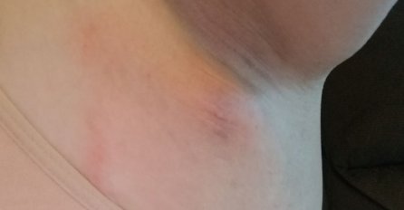 NAPIPALI STE KVRŽICU ISPOD PAZUHA? Ovo je 8 mogućih UZROKA nastanka, a evo kada je SIMPTOM RAKA!