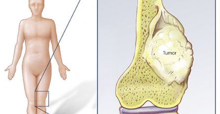 OVO SU PRVI SIMPTOMI RAKA KOSTIJU: Bolest često počinje bez simptoma, ali ako ovo primijetite - OBAVEZNO SE JAVITE LJEKARU 