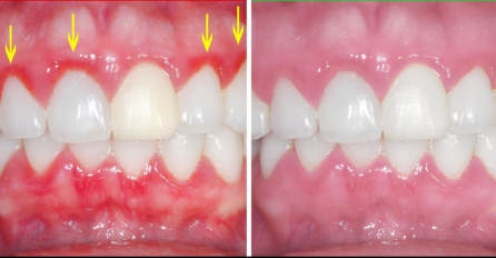 NATEČENO ZUBNO MESO ZNA BITI JAKO BOLNO: Evo šta trebate uraditi da se povuče, NE IGRAJTE SE SA OVIM STANJEM