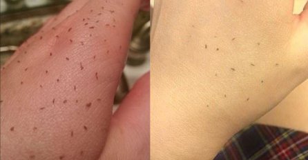 MITESERI SAMI ISPADAJU IZ PORA: Uz ova DVA sastojka koja već imate u kući OČISTITE LICE DO SAVRŠENSTVA!