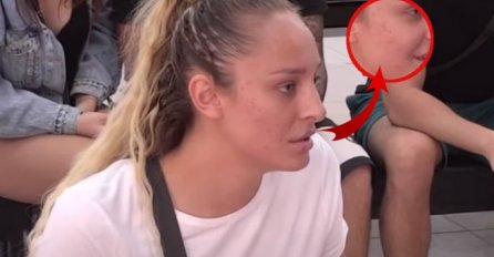LUNA IMALA PROBLEMA SA AKNAMA I BUBULJICAMA: Evo kako je riješila problem, objavila video da svi vide 
