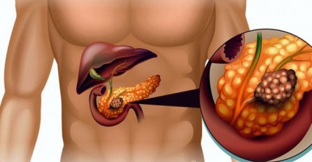 Veći otrov od bijelog hljeba: Ovo pecivo iz pekare je tihi ubica pankreasa, a svi ga jedemo