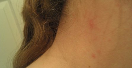 JAVLJAJU VAM SE BUBULJICE NA VRATU? Evo na šta vas tijelo upozorava