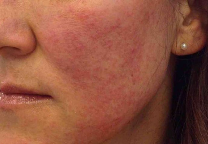 5 GLAVNIH SIMPTOMA LUPUSA: Crvenilo na licu ima TIPIČAN OBLIK, a bolovi su isti na obje strane tijela