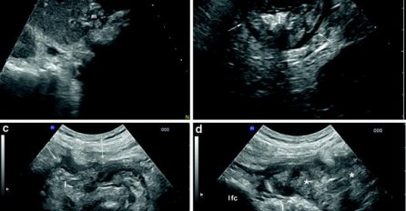 IMAO JE OVAJ SIMPTOM GODINU DANA - DOKTORICA MU OTKRILA RAK DEBELOG CRIJEVA:  Evo šta ne smijete ignorisati