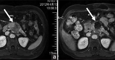 RAK PANKREASA JE TIHI UBICA: Prve simptome je teško otkriti, jer ljudi ne obraćaju pažnju na 1 stvar