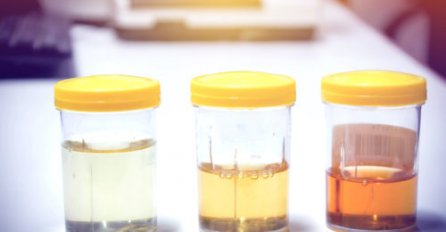 URIN VAM JE TAMAN I IMA JAK MIRIS, ima li razloga za brigu? 6 RAZLOGA ZAŠTO VAM SE TO DOGAĐA