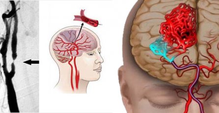 PRVA TRI SATA ODLUČUJU DA LI ĆETE ŽIVJETI:Ako osjetite ove simptome, u pitanju je MOŽDANI UDAR! Evo šta je važno da znate!