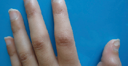 DA LI VAM TRNU RUKE ILI PRSTI? EVO NA ŠTA VAS UPOZORAVA OVAJ SIMPTOM: Na vrijeme obratite pažnju