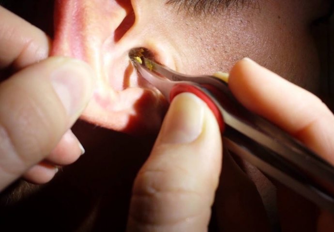 NE VALJA AKO GA IMA PREVIŠE U UŠIMA: Izbacite SAV VOSAK jednostavno i bezbolno, NE TREBAJU VAM ŠTAPIĆI ZA UŠI