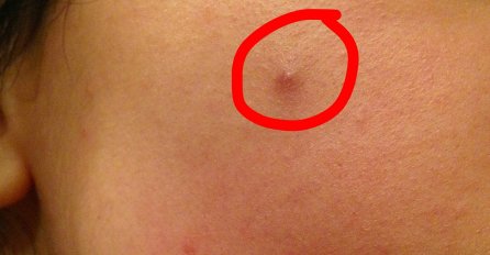 POTKOŽNE BUBULJICE ZNAJU BITI JAKO BOLNE, NI SLUČAJNO IH NE CIJEDITE?  Evo šta trebate uraditi da nestanu