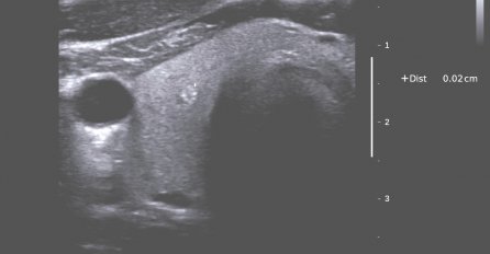 RAK ŠTITNE ŽLIJEZDE SE TEŠKO OTKRIVA: Ovo su PRVI SIMPTOMI koji se javljaju, znak da trebate doktoru