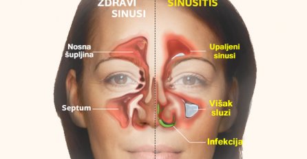 EVO KAKO DA IZLIJEČITE SINUSNU INFEKCIJU JEDNOM ZA SVA VREMENA: Ovaj domaći lijek čini čuda, RECEPT KOJI TREBATE ZNATI