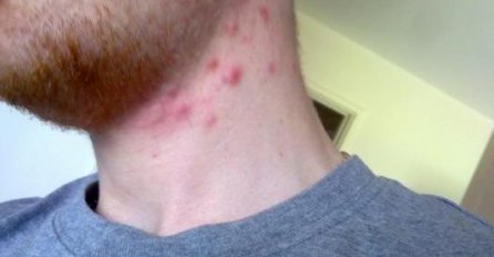 ZNATE LI ZBOG ČEGA SE JAVLJAJU BOBULJICE PO VRATU: Postoji samo jedan način da ih se rijesite, EVO KAKO