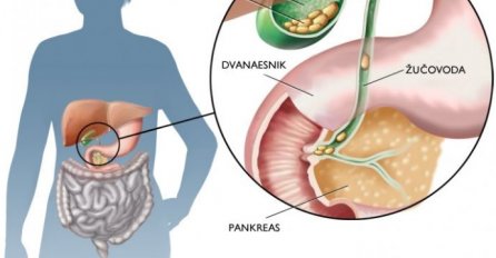 OVO SU SIMPTOMI KOJI UKAZUJU DA IMATE KAMEN U ŽUČI: Bol koja se teško podnosi!