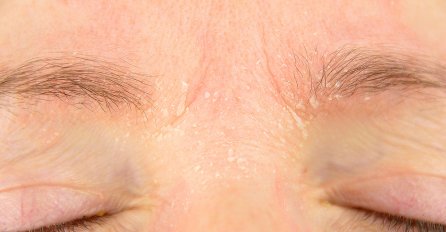 DA LI VAM SE KOŽA NA LICU PERUTA? EVO ŠTA JE U PITANJU: Organizam vam pokušava nešto poručiti