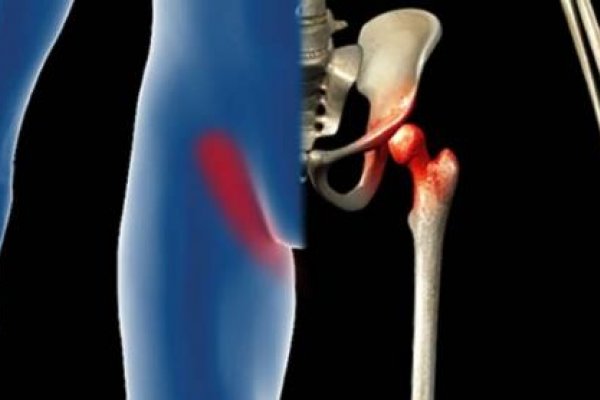 bol u preponskim zglobovima bolna bol i pucketanje u zglobu koljena