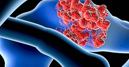 Gotovo 40 posto slučajeva raka u svijetu moglo se spriječiti