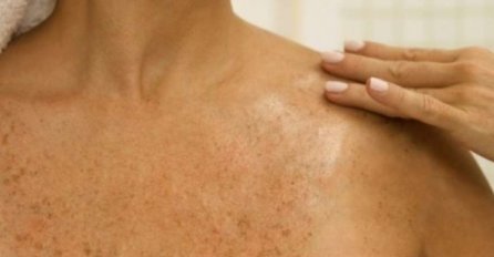 SMEĐE MRLJE SU ČESTE PO TIJELU, ALI POSTOJI NAČIN KAKO DA IH UKLONITE: Dermatolog otkrio tajnu, smjesa ova dva sastojka čini čuda!
