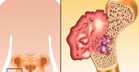 OVO SU PRVI SIMPTOMI RAKA KOSTIJU: Bolest često počinje bez simptoma, ali ako ovo primijetite - OBAVEZNO SE JAVITE LJEKARU 